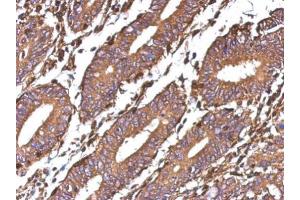 IHC-P Image Immunohistochemical analysis of paraffin-embedded human colon carcinoma, using Galectin 1, antibody at 1:500 dilution. (LGALS1/Galectin 1 antibody)