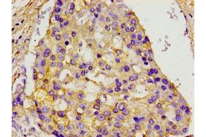 Immunohistochemistry of paraffin-embedded human breast cancer using ABIN7153843 at dilution of 1:100 (GANP antibody  (AA 292-435))