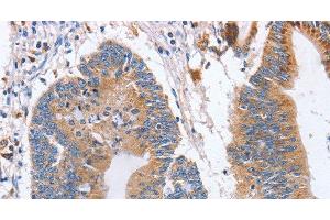 Immunohistochemistry of paraffin-embedded Human colon cancer using CD327 Polyclonal Antibody at dilution of 1:70 (SIGLEC6 antibody)