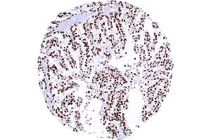 Ovarian clear cell carcinoma with strong Cyclin E1 staining of all tumor cells