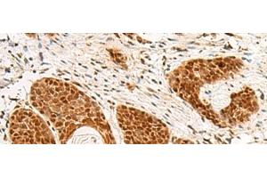 Immunohistochemistry of paraffin-embedded Human esophagus cancer tissue using POM121 Polyclonal Antibody at dilution of 1:75(x200)
