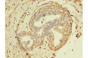 Immunohistochemistry of paraffin-embedded human breast cancer using ABIN7172148 at dilution of 1:100 (THRA antibody  (AA 1-490))