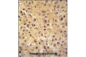WBSCR27 antibody (N-term) (ABIN654505 and ABIN2844234) immunohistochemistry analysis in formalin fixed and paraffin embedded human hepatocarcinoma followed by peroxidase conjugation of the secondary antibody and DAB staining. (WBSCR27 antibody  (N-Term))