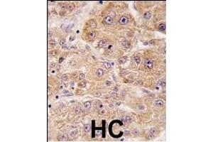 Formalin-fixed and paraffin-embedded human hepatocarcinoma tissue reacted with hUVRAG (C-term), which was peroxidase-conjugated to the secondary antibody, followed by DAB staining. (UVRAG antibody  (C-Term))