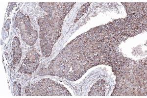 IHC-P Image Immunohistochemical analysis of paraffin-embedded lung SCC xenograft, using MAPK8IP1, antibody at 1:100 dilution. (MAPK8IP1 antibody)