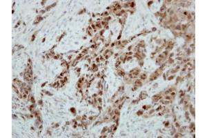 IHC-P Image Immunohistochemical analysis of paraffin-embedded H661 xenograft, using Ataxin 3, antibody at 1:500 dilution.