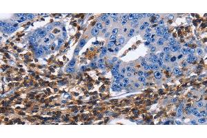Immunohistochemistry of paraffin-embedded Human gastric cancer tissue using CD45 Polyclonal Antibody at dilution 1:40 (CD45 antibody)