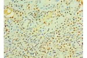 Immunohistochemistry of paraffin-embedded human breast cancer using ABIN7158358 at dilution of 1:100 (LIMK2 antibody  (AA 1-240))