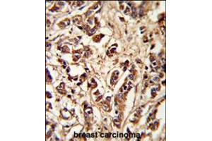 Formalin-fixed and paraffin-embedded human breast carcinoma reacted with PCM-1 Antibody , which was peroxidase-conjugated to the secondary antibody, followed by DAB staining.