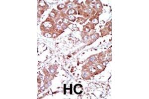 Formalin-fixed and paraffin-embedded human cancer tissue reacted with the primary antibody, which was peroxidase-conjugated to the secondary antibody, followed by DAB staining. (BMPR1A antibody  (AA 166-195))