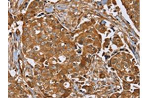 The image on the left is immunohistochemistry of paraffin-embedded Human breast cancer tissue using ABIN7192090(RAB14 Antibody) at dilution 1/40, on the right is treated with synthetic peptide. (RAB14 antibody)