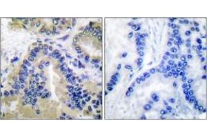 Immunohistochemistry analysis of paraffin-embedded human lung carcinoma tissue, using Caspase 10 Antibody. (Caspase 10 antibody  (AA 430-479))