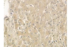 ABIN6265547 and ABIN6276370 at 1/100 staining human hepatocellular carcinoma by IHC-P.