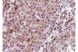ABIN6277783 at 1/100 staining human liver carcinoma tissue sections by IHC-P. (PERK antibody  (pThr982))
