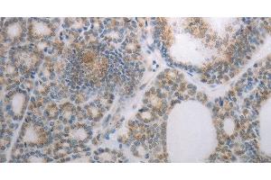 Immunohistochemistry of paraffin-embedded Human thyroid cancer using RBMS3 Polyclonal Antibody at dilution of 1:70 (RBMS3 antibody)