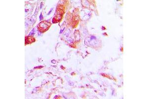 Immunohistochemical analysis of Aquaporin 5 staining in human lung cancer formalin fixed paraffin embedded tissue section. (Aquaporin 5 antibody  (C-Term))