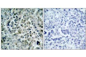 Immunohistochemical analysis of paraffin- embedded human lung carcinoma tissue, using HDAC8 (Ab-39) antibody (E021143). (HDAC8 antibody)