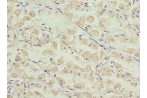 Immunohistochemistry of paraffin-embedded human gastric cancer using ABIN7164276 at dilution of 1:100 (PRICKLE2 antibody  (AA 615-844))