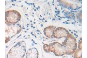 Detection of REG1b in Human Stomach cancer Tissue using Polyclonal Antibody to Regenerating Islet Derived Protein 1 Beta (REG1b) (REG1B antibody  (AA 23-166))