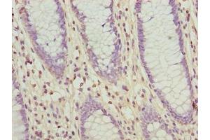 Immunohistochemistry of paraffin-embedded human colon cancer using ABIN7176680 at dilution of 1:100 (SLC3A6 (AA 246-461) antibody)