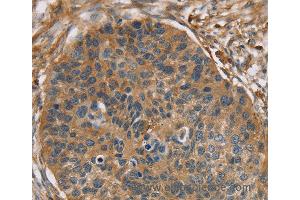 Immunohistochemistry of Human breast cancer using RIPK4 Polyclonal Antibody at dilution of 1:40 (RIPK4 antibody)