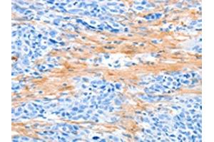 The image on the left is immunohistochemistry of paraffin-embedded Human esophagus cancer tissue using ABIN7189570(AARS Antibody) at dilution 1/50, on the right is treated with synthetic peptide. (AARS antibody)
