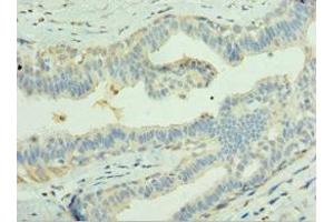 Immunohistochemistry of paraffin-embedded human breast cancer using ABIN7158044 at dilution of 1: 100 (LGI1 antibody  (AA 35-285))