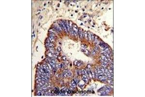 Formalin-fixed and paraffin-embedded human colon carcinoma with P15 Antibody (N-term), which was peroxidase-conjugated to the secondary antibody, followed by DAB staining. (MMP15 antibody  (N-Term))