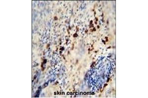 LCE1A antibody (C-term) (ABIN654845 and ABIN2844511) immunohistochemistry analysis in formalin fixed and paraffin embedded human skin carcinoma followed by peroxidase conjugation of the secondary antibody and DAB staining.