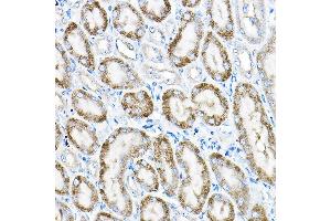 Immunohistochemistry of paraffin-embedded human liver cancer using  Rabbit pAb (ABIN6131168, ABIN6136442, ABIN6136443 and ABIN6224114) at dilution of 1:25 (40x lens). (ACOX1 antibody  (AA 1-270))