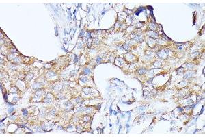 Immunohistochemistry of paraffin-embedded Human breast cancer using CTSF Polyclonal Antibody at dilution of 1:100 (40x lens). (Cathepsin F antibody)