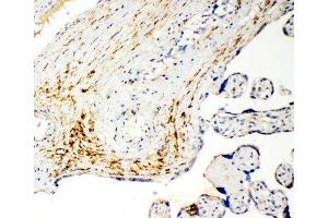 IHC-P: MCT5 antibody testing of human placenta cancer tissue (SLC16A4 antibody  (N-Term))