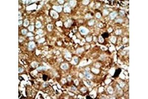IHC analysis of FFPE human hepatocarcinoma tissue stained with the PFKFB3 antibody (PFKFB3 antibody  (AA 454-484))