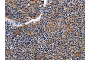 The image on the left is immunohistochemistry of paraffin-embedded Human liver cancer tissue using ABIN7129821(IGSF10 Antibody) at dilution 1/50, on the right is treated with fusion protein.