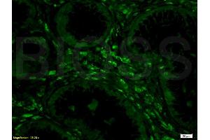 Formalin-fixed and human colon carcinoma tissue labeled with Anti-Phospho-IKK alpha beta (Ser176 Ser180) Polyclonal Antibody, unconjugated (ABIN685183) at 1: 200 followed by incubation with conjugated secondary antibody, Goat Anti-Rabbit IgG, FITC conjugated  , (HIST1H1E antibody  (pThr18))