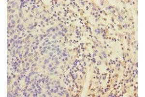 Immunohistochemistry of paraffin-embedded human bladder cancer using ABIN7152192 at dilution of 1:100 (EIF4E2 antibody  (AA 1-240))