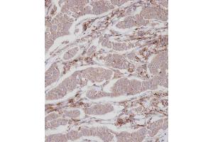 Immunohistochemical analysis of A on paraffin-embedded Human breast carcinoma tissue. (ENOX2 antibody  (N-Term))