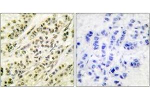 Immunohistochemistry analysis of paraffin-embedded human breast carcinoma tissue, using SKP1A/p19 Antibody. (SKP1 antibody  (AA 41-90))
