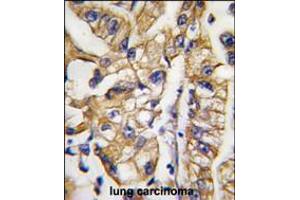 Formalin-fixed and paraffin-embedded human lung carcinoma tissue reacted with HDBP1 Antibody , which was peroxidase-conjugated to the secondary antibody, followed by DAB staining. (SLC2A4RG antibody  (AA 213-242))