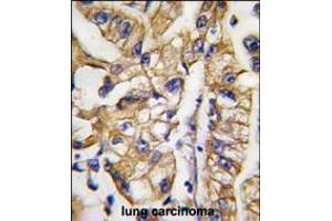 Formalin-fixed and paraffin-embedded human lung carcinoma tissue reacted with HDBP1 Antibody , which was peroxidase-conjugated to the secondary antibody, followed by DAB staining.