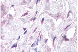 Human Breast, Fibroblasts (formalin-fixed, paraffin-embedded) stained with CXCL12 antibody ABIN214748 at 5 ug/ml followed by biotinylated goat anti-rabbit IgG secondary antibody ABIN481713, alkaline phosphatase-streptavidin and chromogen. (CXCL12 antibody  (C-Term))