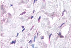 Human Breast, Fibroblasts (formalin-fixed, paraffin-embedded) stained with CXCL12 antibody ABIN214748 at 5 ug/ml followed by biotinylated goat anti-rabbit IgG secondary antibody ABIN481713, alkaline phosphatase-streptavidin and chromogen.