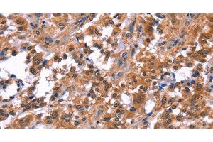 Immunohistochemistry of paraffin-embedded Human thyroid cancer tissue using PIP5K1B Polyclonal Antibody at dilution 1:30 (PIP5K1B antibody)