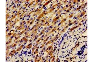 Immunohistochemistry of paraffin-embedded human liver cancer using ABIN7145416 at dilution of 1:100 (APOH antibody  (AA 119-345))