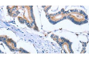 Immunohistochemistry of paraffin-embedded Human colon cancer tissue using FNK Polyclonal Antibody at dilution 1:30 (PLK3 antibody)
