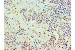 Immunohistochemistry of paraffin-embedded human breast cancer using ABIN7162382 at dilution of 1:100 (HIV-1 Tat Interactive Protein 2, 30kDa (HTATIP2) (AA 1-230) antibody)
