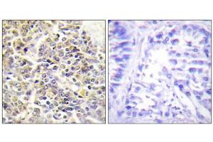 Immunohistochemistry analysis of paraffin-embedded human lung carcinoma tissue using ASC antibody.