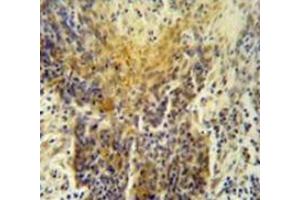 Immunohistochemistry analysis in human lung carcinoma (Formalin-fixed, Paraffin-embedded), using MRPS24 Antibody , followed by peroxidase conjugation of the secondary antibody and DAB staining. (MRPS24 antibody  (Middle Region))