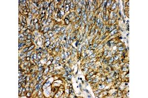Anti-Aquaporin 6 antibody, IHC(P) IHC(P): Human Lung Cancer Tissue (AQP6 antibody  (C-Term))