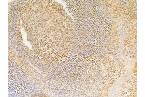 ABIN7095311 and ABIN7099368 at 1/100 staining human tongue carcinoma by IHC-P. (SOHLH2 antibody)